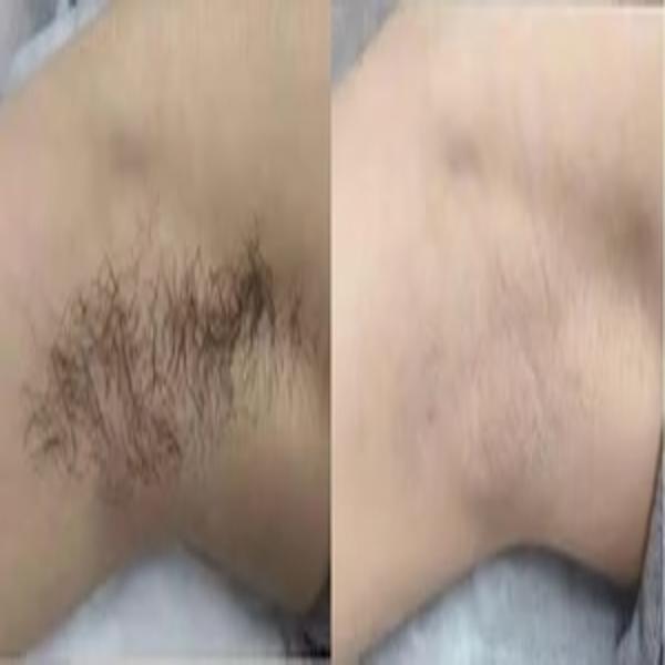 Smooth Skin Hair Inhibitor Spray